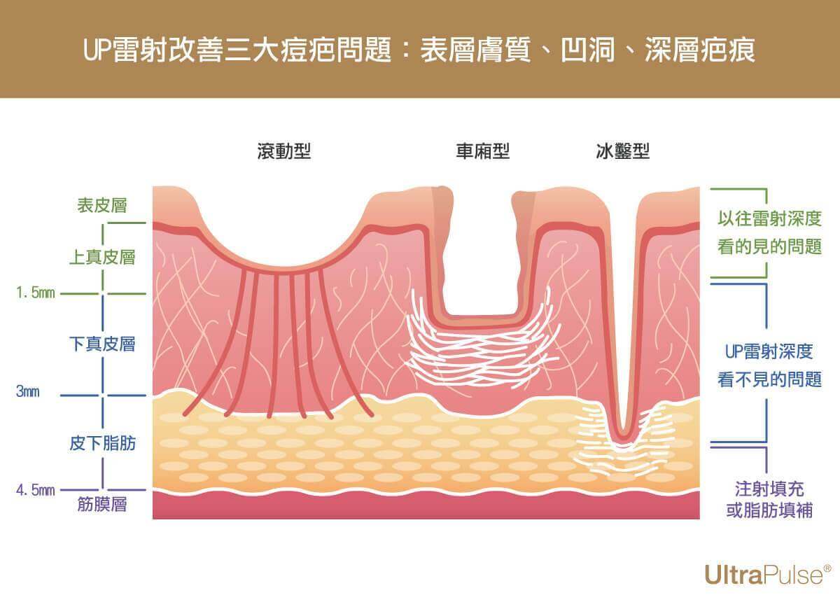 北安勤美up雷射