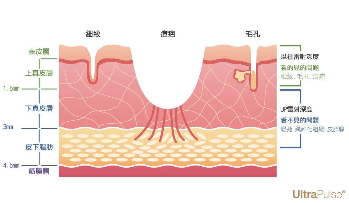 北安勤美up雷射