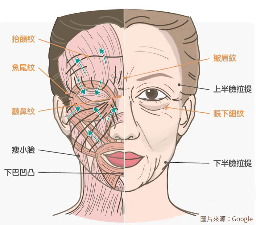肉毒桿菌素 臉部肌肉與表面紋路 2